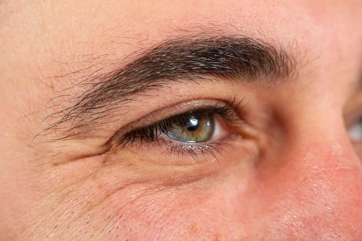 Patas De Gallo En Hombres